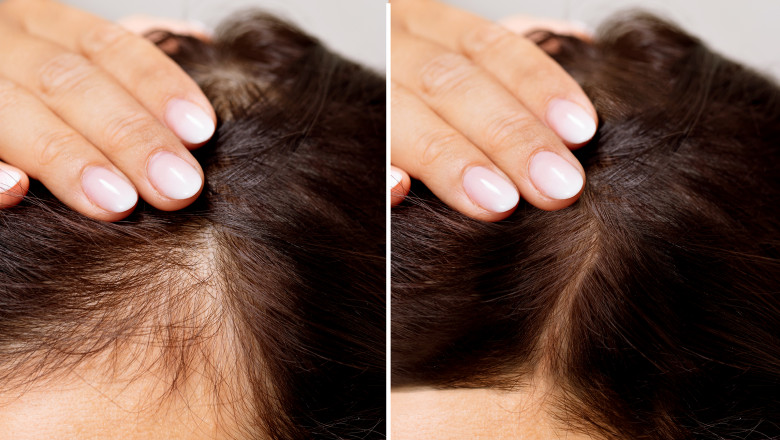Who Should Seek Out Non-Surgical Hair Options in Dallas?
