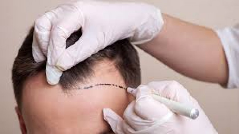 Hair Transplant Brighton and Hove in UK