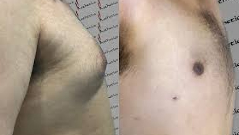 Complete Guide to Male Breast Reduction Islamabad: What You Need to Know