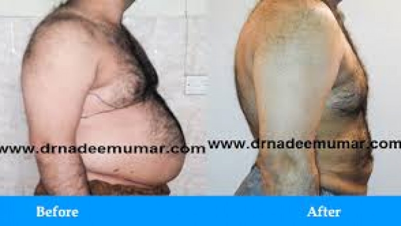 What Sets Liposuction in Islamabad Apart? Exploring Advanced Technologies