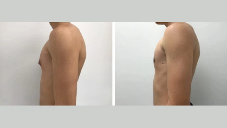 How Dubai’s Best Surgeon Helps Men Recover Faster from Gynecomastia Surgery