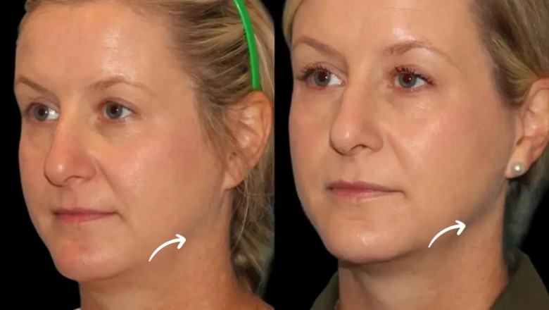 The Best Plastic Surgeon in Dubai Explains Where Sculptra Fillers Work Best