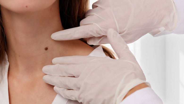 Everything You Need to Know About Removing Skin Tags