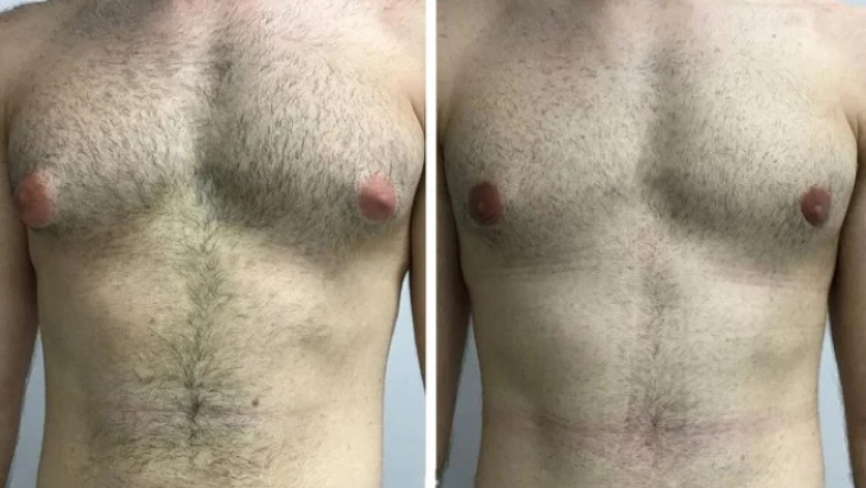 Success Stories from the Best Gynecomastia Surgeons in Dubai