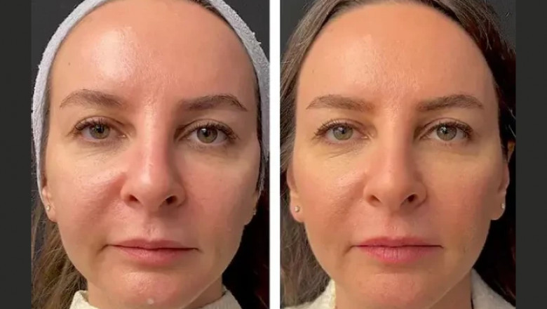 What to Expect: Mesotherapy Journey with the Best Doctors in Dubai
