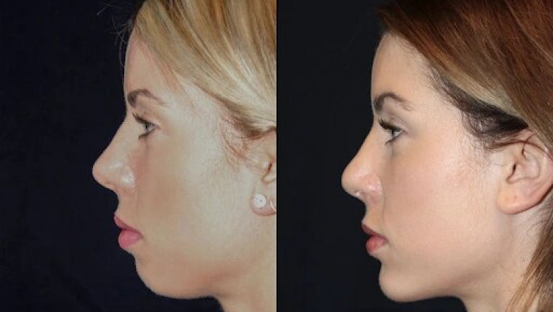 Best Doctors in dubai for Chin Fillers: How to Enhance Your Chin Shape and Volume