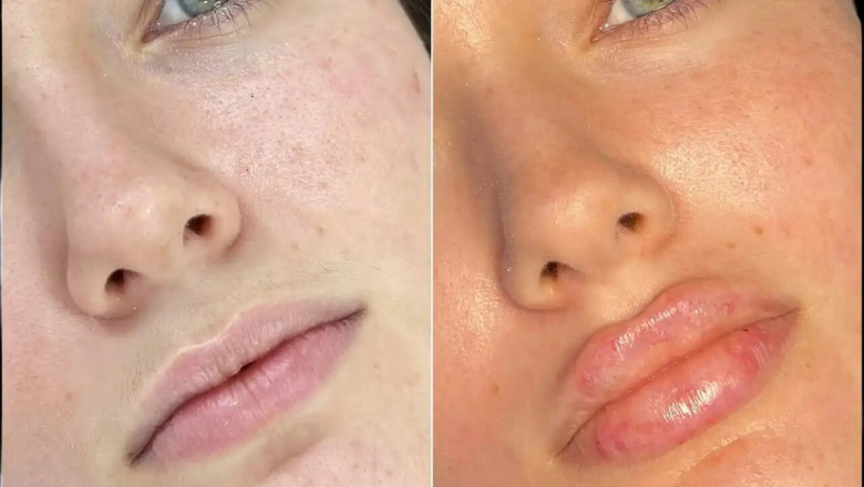 Best Doctors in dubai for Fillers: Patient-Centered Approach