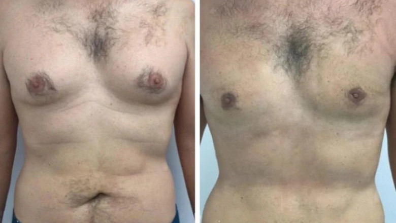The Role of Gynecomastia in Dubai Surgery in Regaining Confidence